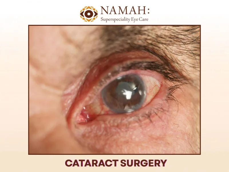 Cataract Surgery